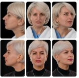 Before and after rhinoplasty results at Yurchenko Plastic Surgery Team, improved nose profile