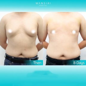 Before and after liposuction results at Wansiri Hospital, visible body contour improvement