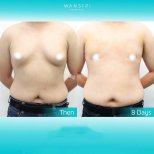 Before and after liposuction results at Wansiri Hospital, visible body contour improvement