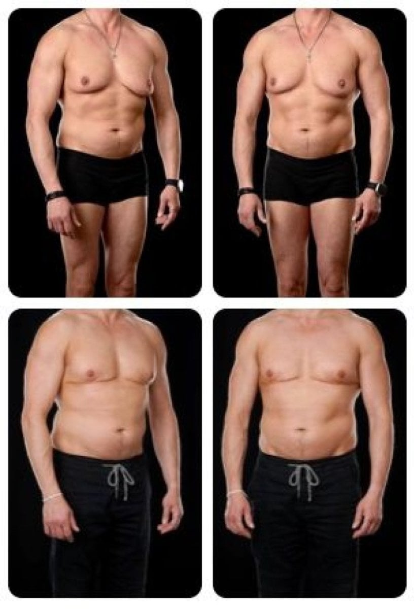 Resultados antes y después de ginecomastia en Yurchenko Plastic Surgery Team, contorno torácico