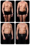 Before and after gynecomastia surgery results at Yurchenko Plastic Surgery Team, male chest contour
