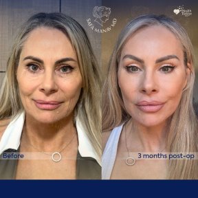 Vorher-nachher-Ergebnis Gesichts-Fetttransfer bei Dr. Safa Manav Clinic, 3 Monate post-op