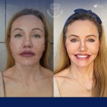 Vorher-nachher-Ergebnis der Gesichts-Fetttransfer bei Dr. Safa Manav Clinic
