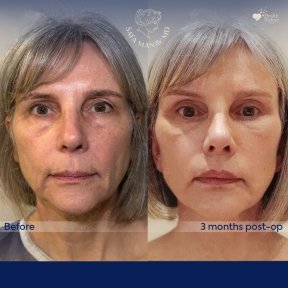 Vorher-nachher-Ergebnis des Facial Fat Transfer in der Dr. Safa Manav Klinik, 3 Monate post-op