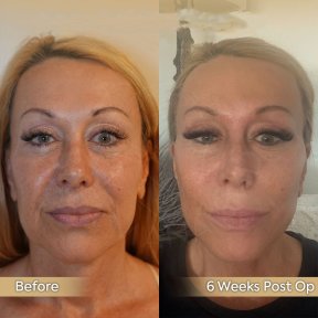 Vorher-nachher-Ergebnis des Facial Fat Transfer in der Dr. Safa Manav Klinik, 6 Wochen post-op