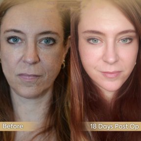 Vorher-nachher-Ergebnis des Facial Fat Transfer in der Dr. Safa Manav Klinik, 18 Tage post-op