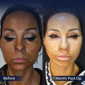 Deep Plane Facelift Vorher-Nachher-Ergebnis bei Dr. Safa Manav Clinic, 1 Monat post-op
