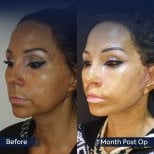 Vorher-nachher-Ergebnis Deep Plane Facelift bei Dr. Safa Manav Clinic, sichtbare Verjüngung