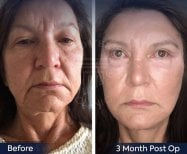 Vorher-nachher-Ergebnis Deep Plane Facelift bei Dr. Safa Manav Clinic, 3 Monate post-op