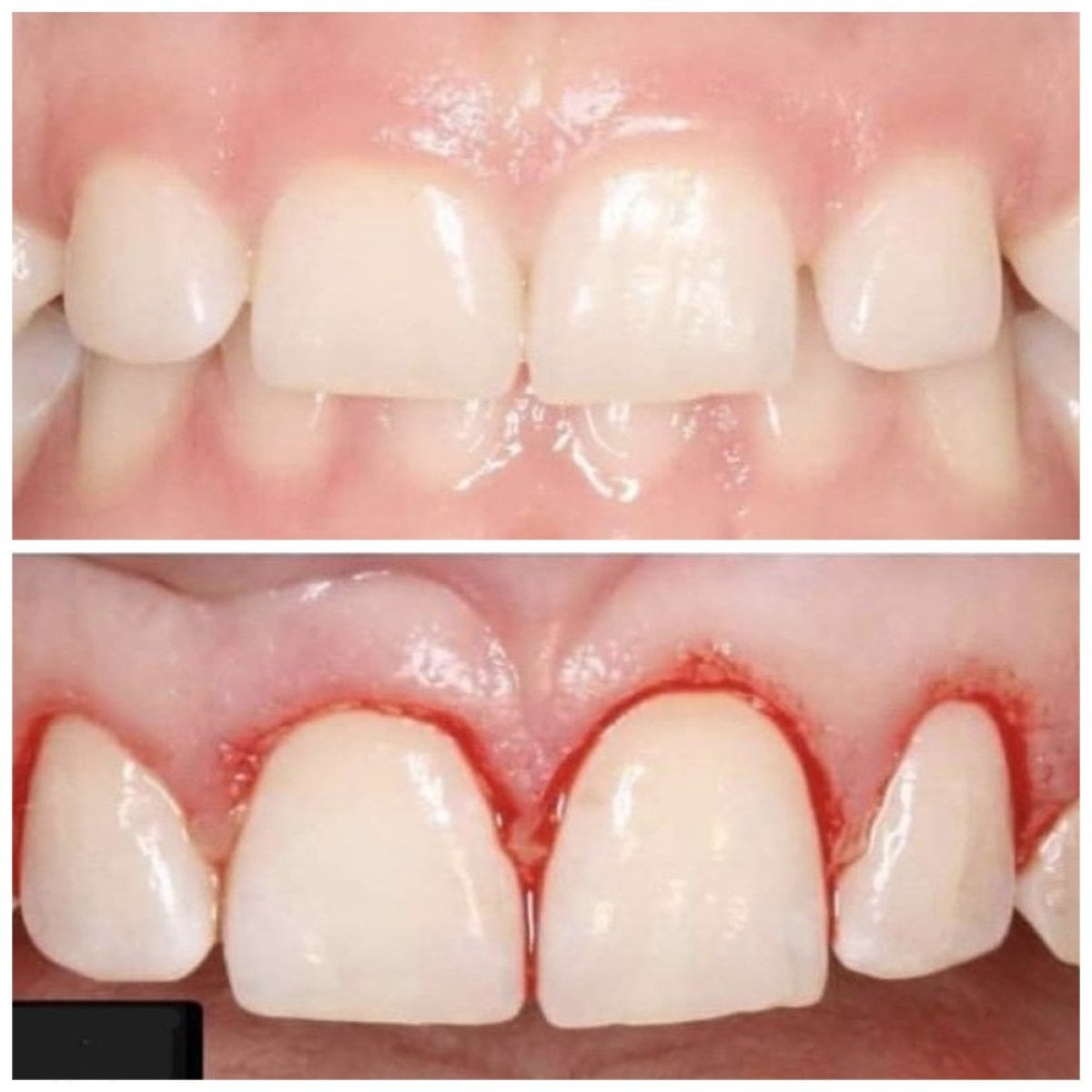 نتائج قبل وبعد جراحة اللثة في SoftDentalCare Clinic، تحسن شكل اللثة واضح