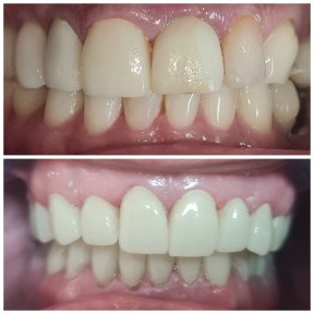 Vorher-nachher-Ergebnis der Zahnfleischchirurgie bei SoftDentalCare Clinic, verbesserte Zahnlinie