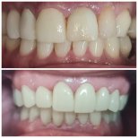 Vorher-nachher-Ergebnis der Zahnfleischchirurgie bei SoftDentalCare Clinic, verbesserte Zahnlinie