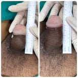 Resultados de aumento de pene antes y después en Eternity Clinic Pleonchit, mayor longitud visible