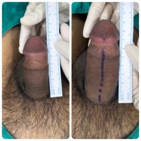Resultados de alargamiento de pene antes y después en Eternity Clinic Pleonchit, mayor longitud visible