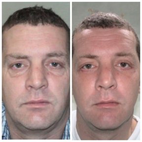 Результаты до и после фейслифтинга в Bangkok Plastic Surgery, заметное омоложение лица