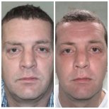 Результаты до и после фейслифтинга в Bangkok Plastic Surgery, заметное омоложение лица
