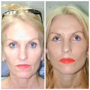 Результаты до и после подтяжки лица в Bangkok Plastic Surgery – омоложение лица
