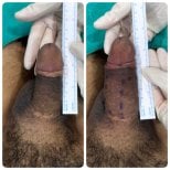 Resultados antes y después de relleno de pene: aumento visible del grosor tras el procedimiento