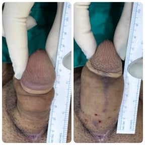 Resultados antes y después de relleno de pene – aumento visible del grosor