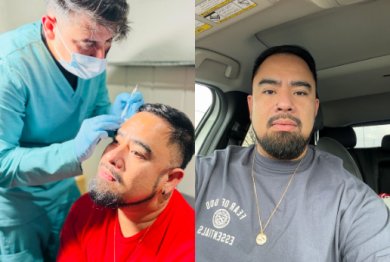 Before and after stem cell rejuvenation therapy results at Aura Regenerative Center, anti-aging