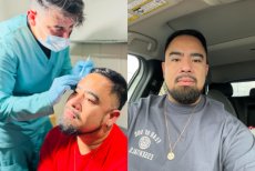 Before and after stem cell rejuvenation therapy results at Aura Regenerative Center, anti-aging