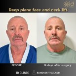 Before and after deep plane facelift and neck lift results at ID Clinic Bangkok, 14 days post-op