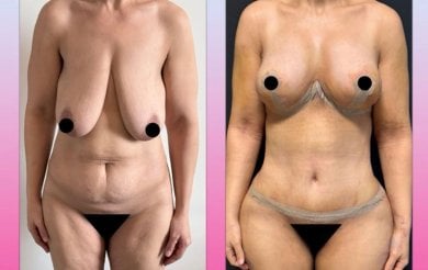 Before and after tummy tuck and breast lift results at Dr. Safa Manav Clinic, body contouring