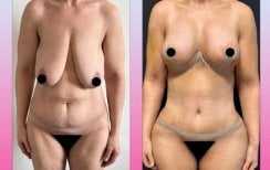 Before and after tummy tuck and breast lift results at Dr. Safa Manav Clinic, body contouring