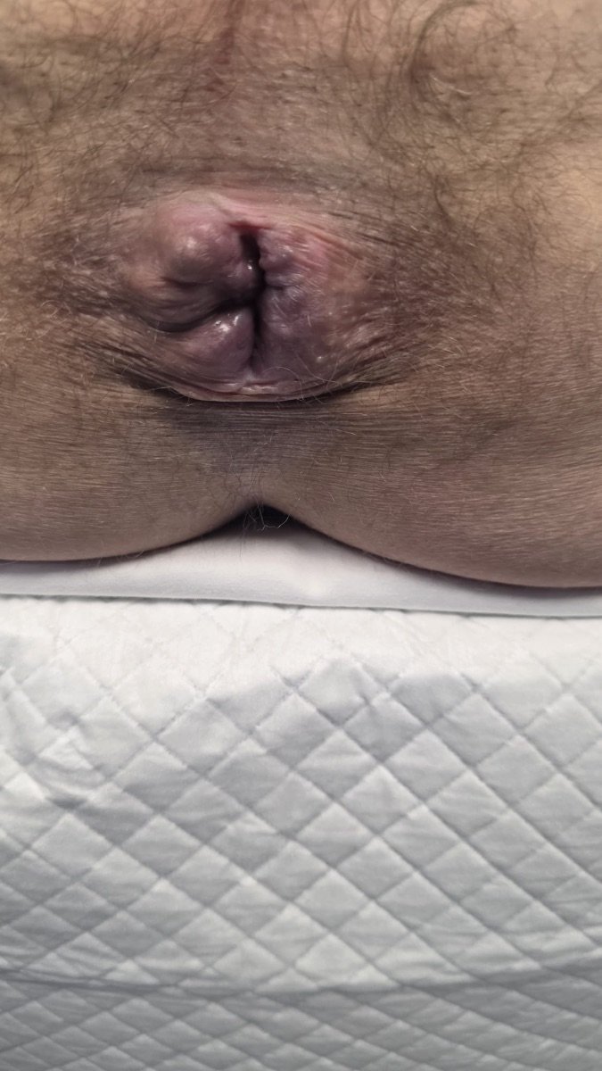 نتيجة علاج البواسير في عيادة Digestive Surgery and Gastroenterology Centro PAD