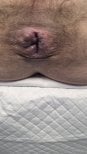 Ergebnis der Hämorrhoidenbehandlung in der Klinik Digestive Surgery and Gastroenterology Centro PAD