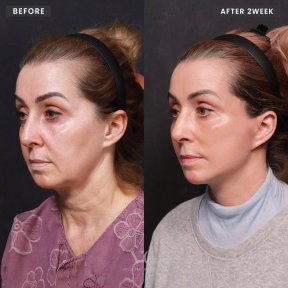 Vorher-nachher-Ergebnis Deep Plane Facelift bei VG Plastic Surgery, sichtbare Verjüngung