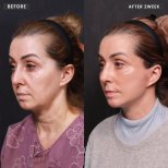 Vorher-nachher-Ergebnis Deep Plane Facelift bei VG Plastic Surgery, sichtbare Verjüngung