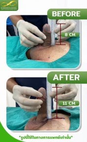 Before and after surgical penile lengthening results at Eternity Clinic Pleonchit, increased length