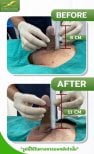 Before and after surgical penile lengthening results at Eternity Clinic Pleonchit, increased length
