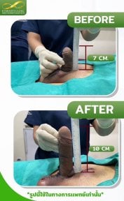Before and after surgical penile lengthening results at Eternity Clinic Pleonchit, increased length