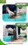 Before and after surgical penile lengthening results at Eternity Clinic Pleonchit, increased length