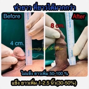 Before and after surgical penile lengthening results at Eternity Clinic Pleonchit, increased length