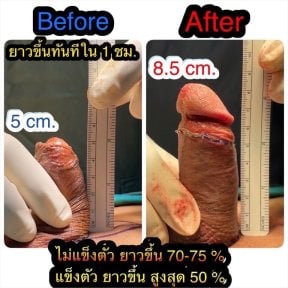 Before and after surgical penile lengthening results at Eternity Clinic Pleonchit, increased length
