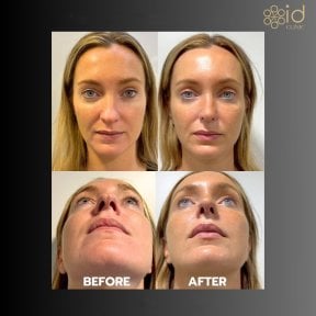 Before and after septoplasty results at ID Clinic Bangkok for deviated septum correction