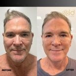 Before and after deep plane facelift results at ID Clinic Bangkok, visible facial rejuvenation