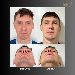 Before and after septoplasty results at ID Clinic Bangkok for deviated septum correction