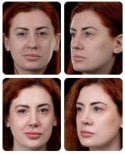 Before and after rhinoplasty results at Yurchenko Plastic Surgery Team, improved nose shape