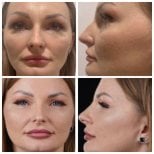 Before and after rhinoplasty results at Yurchenko Plastic Surgery Team, nose reshaping