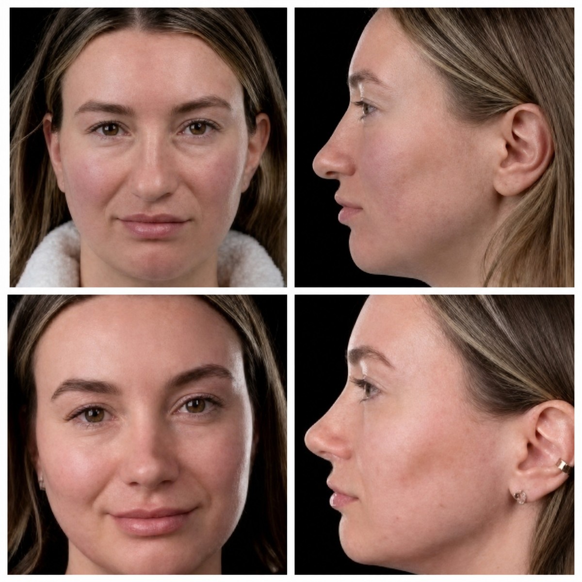 Resultados de rinoplastia antes y después en Yurchenko Plastic Surgery Team, remodelación nasal