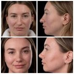 Before and after rhinoplasty results at Yurchenko Plastic Surgery Team, nose reshaping