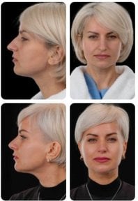 Before and after rhinoplasty results at Yurchenko Plastic Surgery Team, improved nose shape