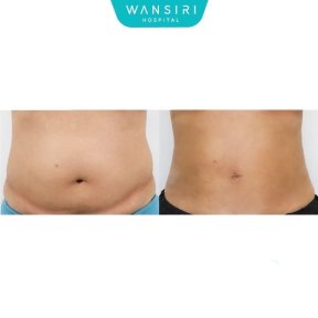 Before and after liposuction results at Wansiri Hospital, visible abdominal contour improvement