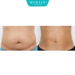 Before and after liposuction results at Wansiri Hospital, visible abdominal contour improvement