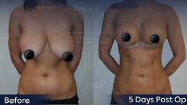 Before and after tummy tuck and breast lift results at Dr. Safa Manav Clinic, 5 days post-op