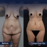 Before and after tummy tuck results at Dr. Safa Manav Clinic, visible abdominal contouring
